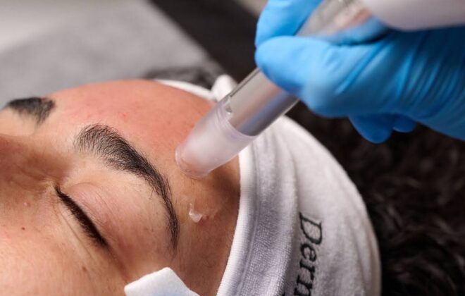 microneedling a face using twist microneedling